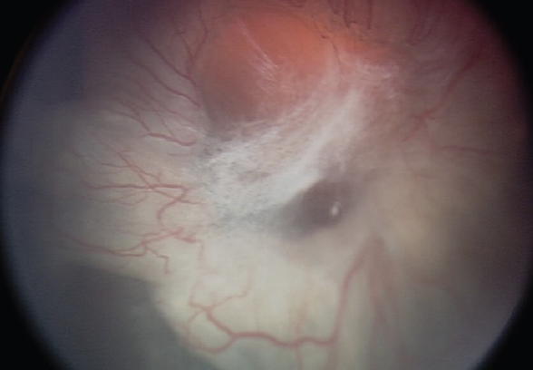Figure 3. Stage 5 FEVR presents with total tractional retinal detachment. Note the complexity of the proliferative tissue.